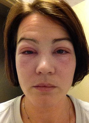 Chemical Burns or Allergic Reactions: A Lash Artist